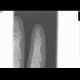 Fracture of the distal phalangeal tuberosity: X-ray - Plain radiograph